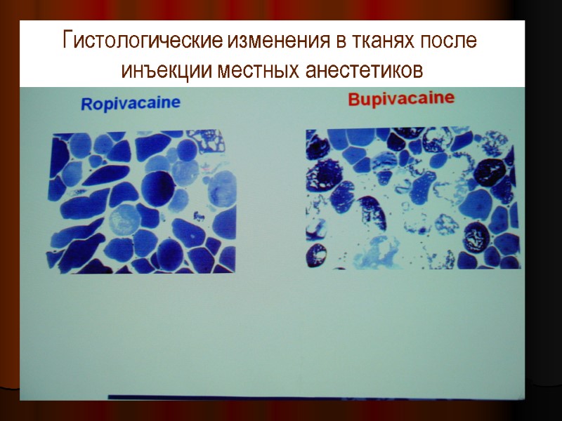 Гистологические изменения в тканях после  инъекции местных анестетиков